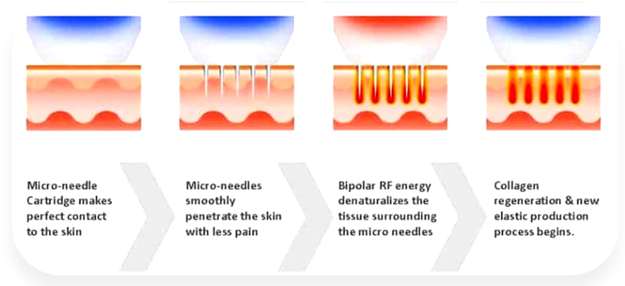 Microneedling process with RF energy illustration.